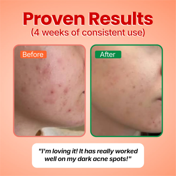 Before and after photo from a customer using Fade Theory for four weeks, showing faded dark acne marks on the cheek