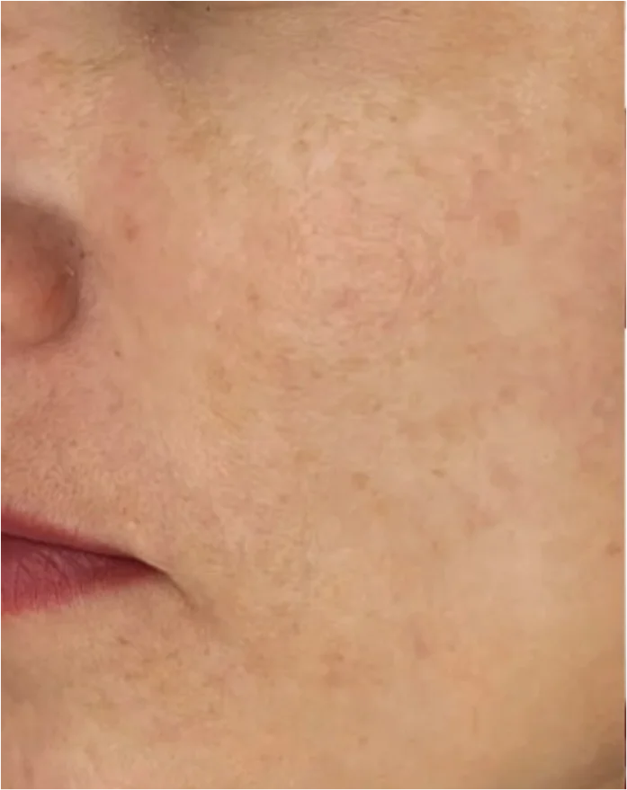 After consistent use of Fade Theory: the same cheek with those dark patches visibly faded