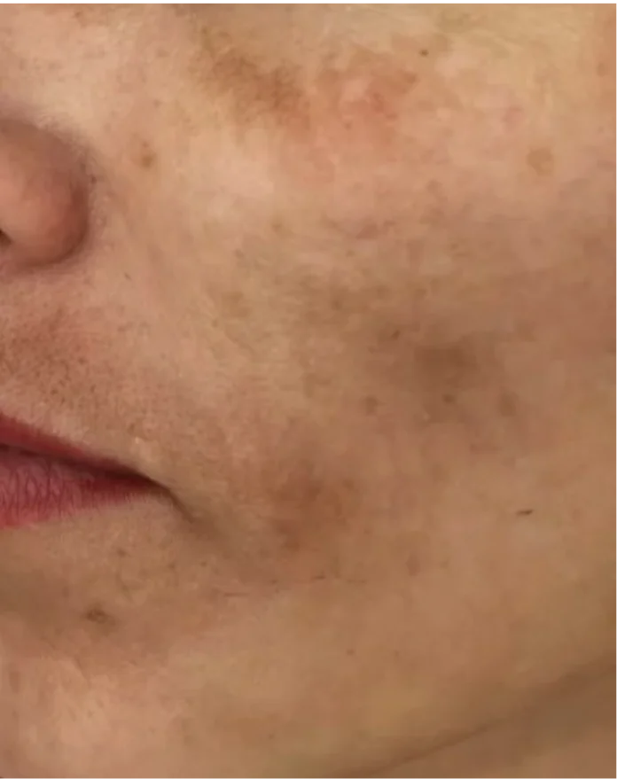 Before: dark patches and post-acne marks across a customer's cheek on brown skin